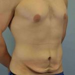 Tummy Tuck Before & After Patient #10846