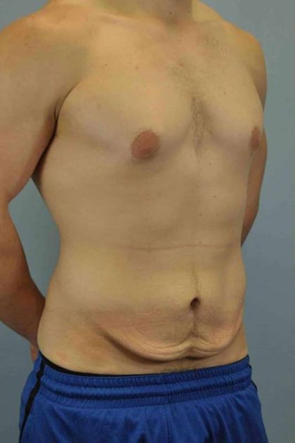 Tummy Tuck Before & After Patient #10846