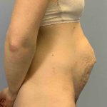 Tummy Tuck Before & After Patient #10862