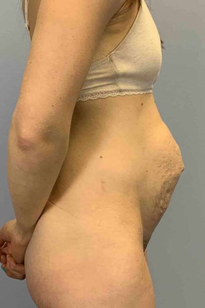 Tummy Tuck Before & After Patient #10862