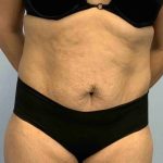 Tummy Tuck Before & After Patient #10869