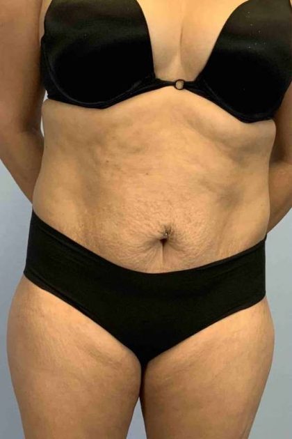 Tummy Tuck Before & After Patient #10869