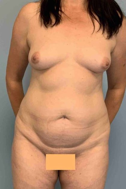 Tummy Tuck Before & After Patient #10874