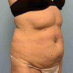 Tummy Tuck Before & After Patient #10881