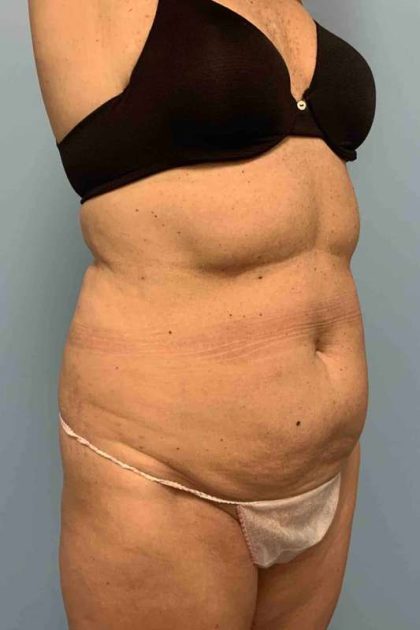 Tummy Tuck Before & After Patient #10881