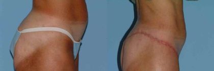 Thigh Surgery Before & After Patient #10890