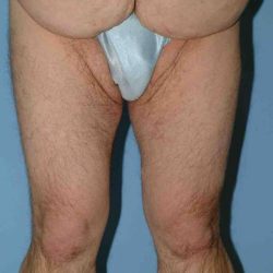 Thigh Surgery Before & After Patient #10893