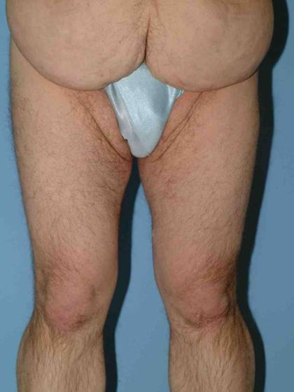 Thigh Surgery Before & After Patient #10893