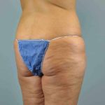 Thigh Surgery Before & After Patient #10900
