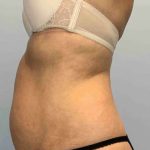 Renuvion Before & After Patient #10935