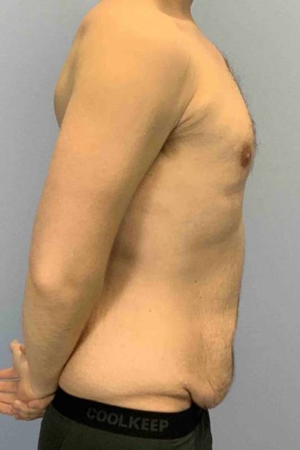 Renuvion Before & After Patient #10944