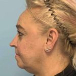 Renuvion Before & After Patient #10951