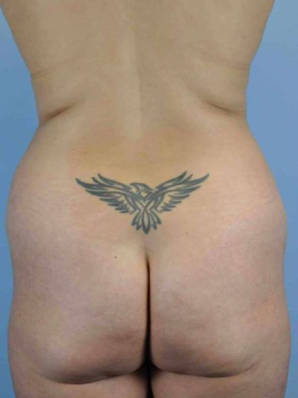 Renuvion Before & After Patient #10960