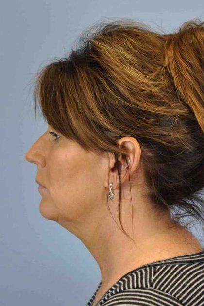 Renuvion Before & After Patient #10971