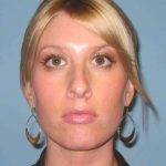 Nose Surgery Before & After Patient #10990