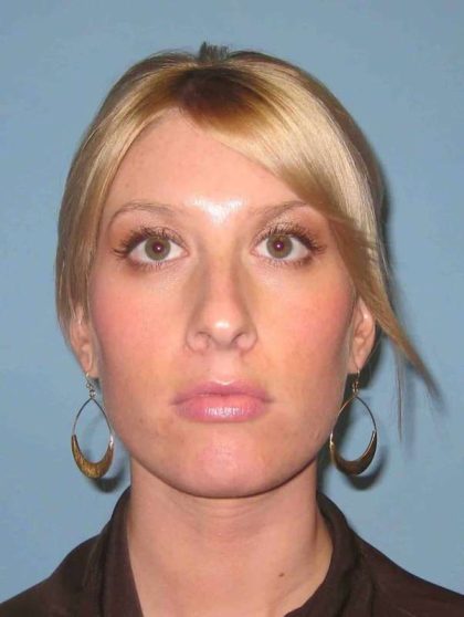 Nose Surgery Before & After Patient #10990