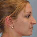 Nose Surgery Before & After Patient #10997