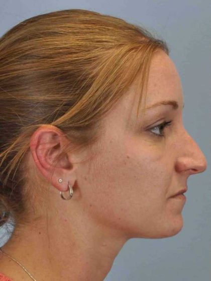 Nose Surgery Before & After Patient #10997