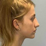 Nose Surgery Before & After Patient #11004