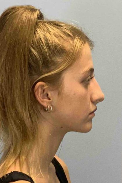 Nose Surgery Before & After Patient #11004