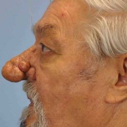 Nose Surgery Before & After Patient #11011