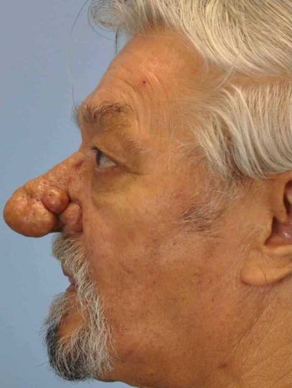 Nose Surgery Before & After Patient #11011