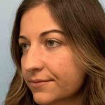 Nose Surgery Before & After Patient #11025