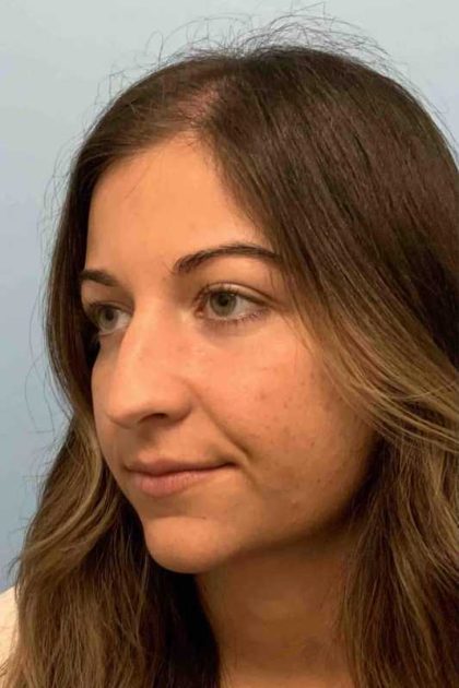 Nose Surgery Before & After Patient #11025