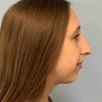 Nose Surgery Before & After Patient #11032