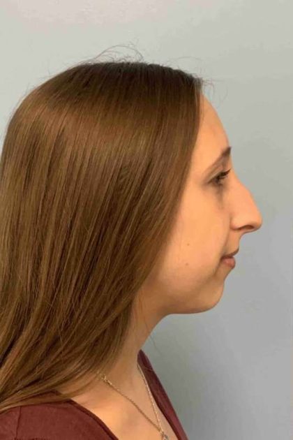 Nose Surgery Before & After Patient #11032