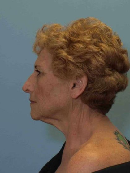 Neck Lift Before & After Patient #11046