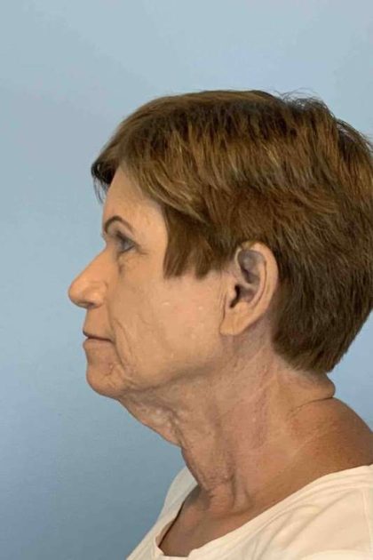 Neck Lift Before & After Patient #11092