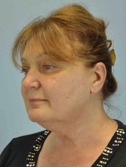 Neck Lift Before & After Patient #11097
