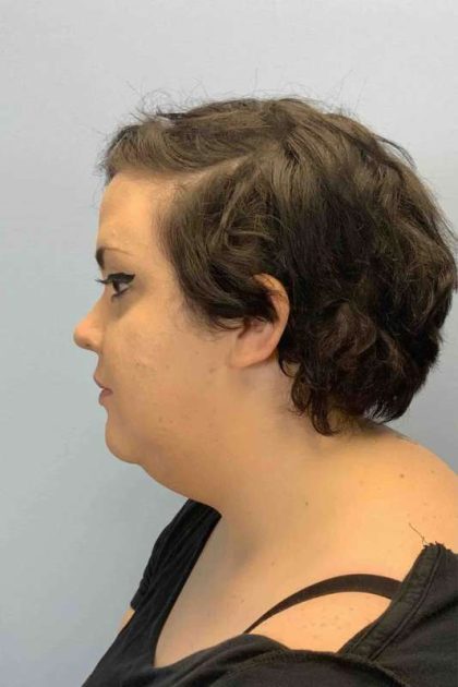 Neck Lift Before & After Patient #11120