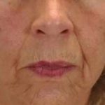 Lip Augmentation Before & After Patient #11148