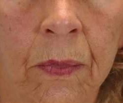 Lip Augmentation Before & After Patient #11148