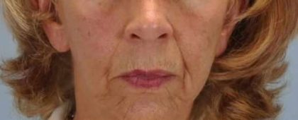 Lip Augmentation Before & After Patient #11148