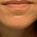 Lip Augmentation Before & After Patient #11151
