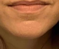 Lip Augmentation Before & After Patient #11151