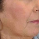 Lip Augmentation Before & After Patient #11163