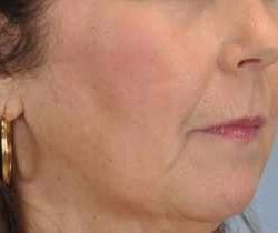 Lip Augmentation Before & After Patient #11163