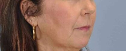 Lip Augmentation Before & After Patient #11163