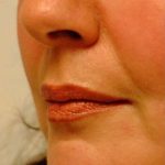 Lip Augmentation Before & After Patient #11175