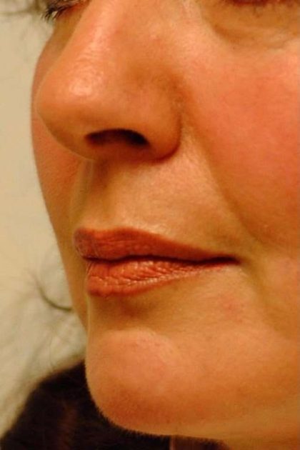 Lip Augmentation Before & After Patient #11175