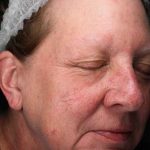 Laser Resurfacing Before & After Patient #11182