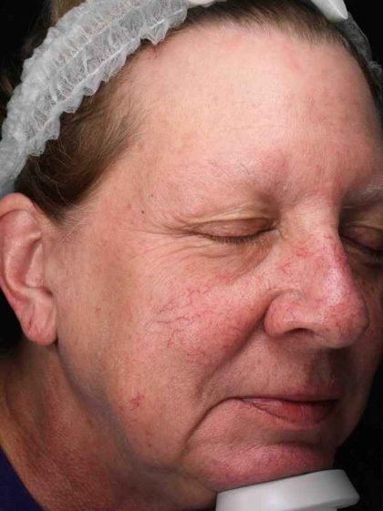 Laser Resurfacing Before & After Patient #11182