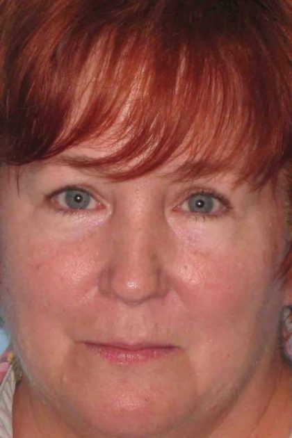 Laser Resurfacing Before & After Patient #11185