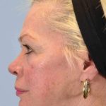 Laser Resurfacing Before & After Patient #11192