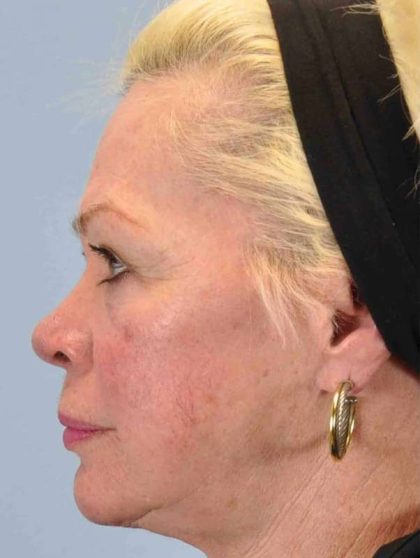 Laser Resurfacing Before & After Patient #11192