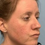 Laser Resurfacing Before & After Patient #11197